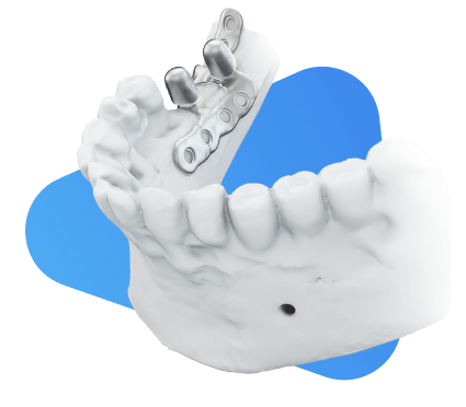 Восстановим любые зубы без сверления кости