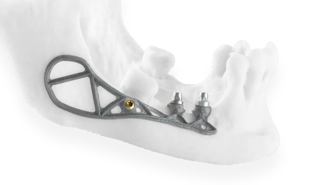 Субпериостальные импланты